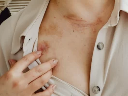 Une manière simple de soigner en douceur les différentes blessures